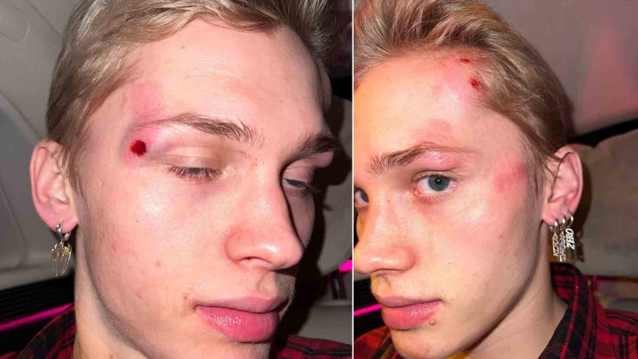 Блогеру Даниле Милохину разбили лицо в центре Москвы