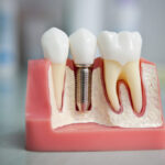 <span class="title">Методы имплантации зубов в клинике Ортодонт Комплекс</span>