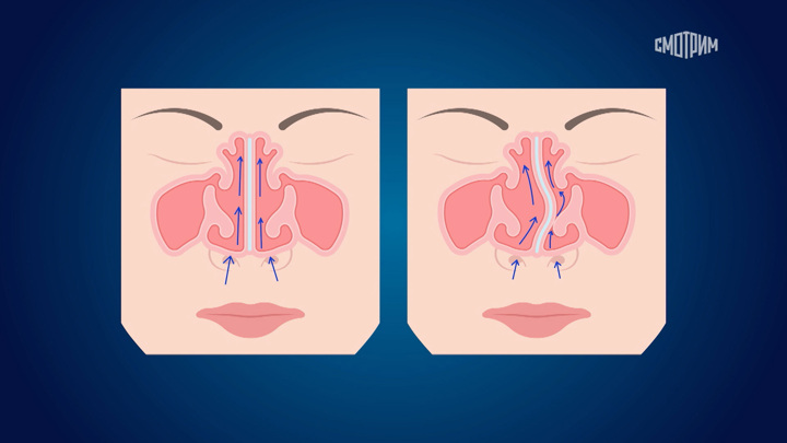 Когда необходимо оперировать искривленную носовую перегородку — Новости на Вести.ru